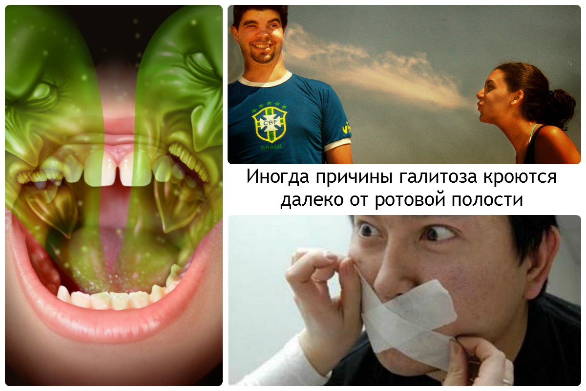 Хронический запах изо рта. Экстраоральный галитоз. Галитоз лечение.